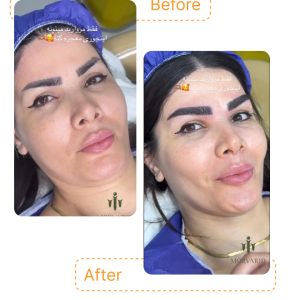 این تکنیک حرفه‌ای ابروها را پرپشت و خوش‌فرم می‌کند و جلوه‌ای طبیعی و متناسب با صورت ایجاد می‌کند.