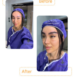 چهره‌ای طبیعی، ابروهایی مرتب و طوری که همه فکر می‌کنن لیفت شده، در حالی‌که همه‌چیز فقط با کاشت ظریف تارها انجام شده ✨