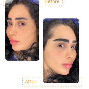 چهره‌ای طبیعی، ابروهایی منظم و اثری شبیه لیفت، فقط با کاشت ظریف و دقیق تارها