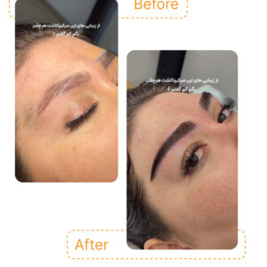 وقتی میکروکاشت درست انجام بشه، نتیجه میشه یه تغییر ظریف که کل چهره رو متحول می‌کنه